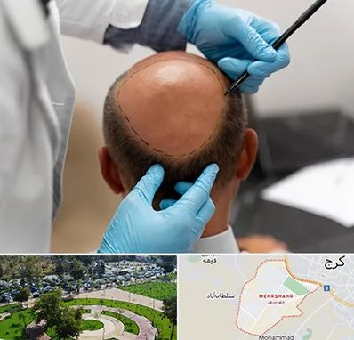 آموزش کاشت مو در مهرشهر کرج 