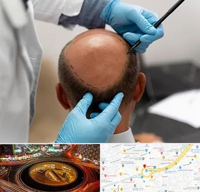 آموزش کاشت مو در میدان ولیعصر 