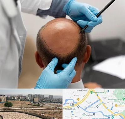 آموزش کاشت مو در کوی وحدت شیراز 