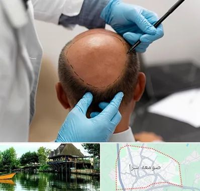 آموزش کاشت مو در صومعه سرا