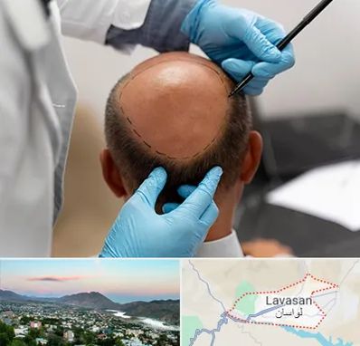 آموزش کاشت مو در لواسان