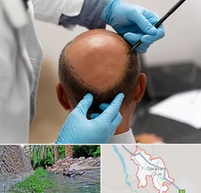 آموزش کاشت مو در سراوان