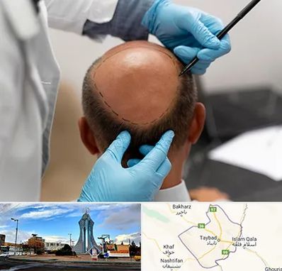 آموزش کاشت مو در تایباد