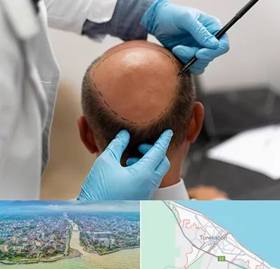 آموزش کاشت مو در تنکابن
