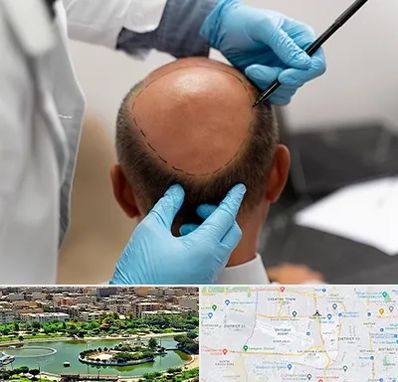 آموزش کاشت مو در منطقه 9 تهران 