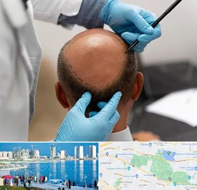 آموزش کاشت مو در چیتگر 