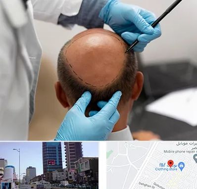 آموزش کاشت مو در چهارراه طالقانی کرج 