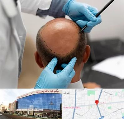 آموزش کاشت مو در نصف راه تبریز