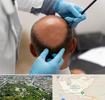 آموزش کاشت مو در شهرکرد