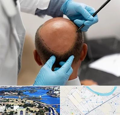 آموزش کاشت مو در کوروش اهواز 