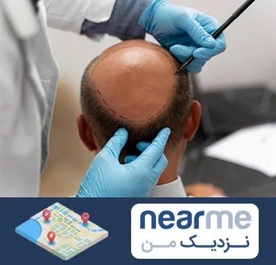 آموزش کاشت مو در نزدیک من