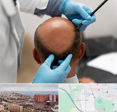 آموزش کاشت مو در سهند تبریز