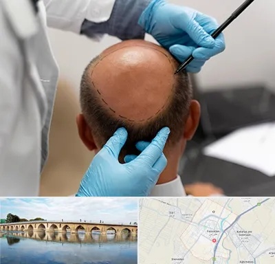 آموزش کاشت مو در فلاورجان