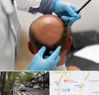 آموزش کاشت مو در ظفر 