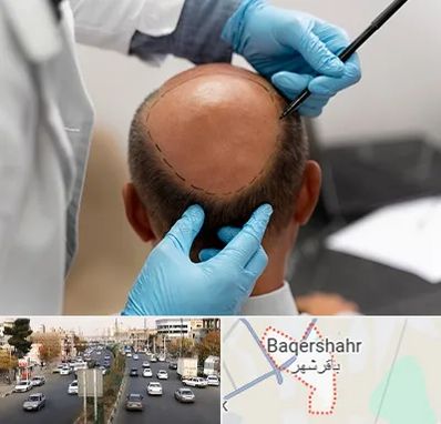 آموزش کاشت مو در باقرشهر