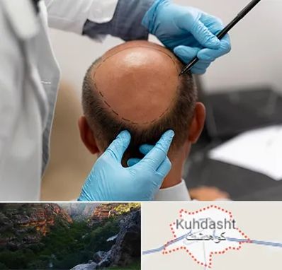 آموزش کاشت مو در کوهدشت