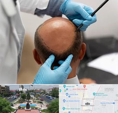 آموزش کاشت مو در بهارستان 