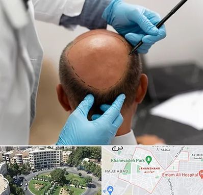 آموزش کاشت مو در جهانشهر کرج 