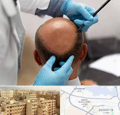آموزش کاشت مو در جنوب غرب تهران