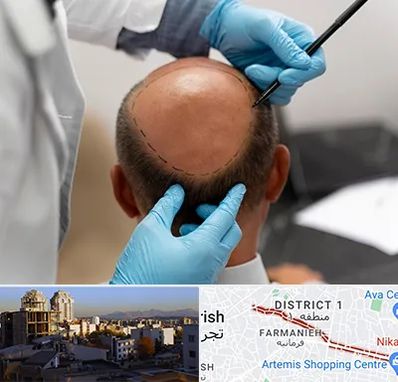 آموزش کاشت مو در فرمانیه 