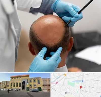 آموزش کاشت مو در زنبیل آباد قم