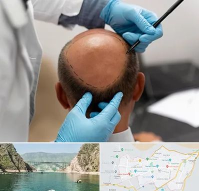 آموزش کاشت مو در ایلام