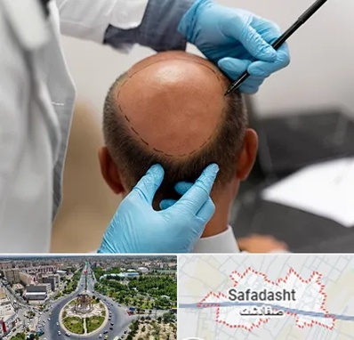 آموزش کاشت مو در صفادشت