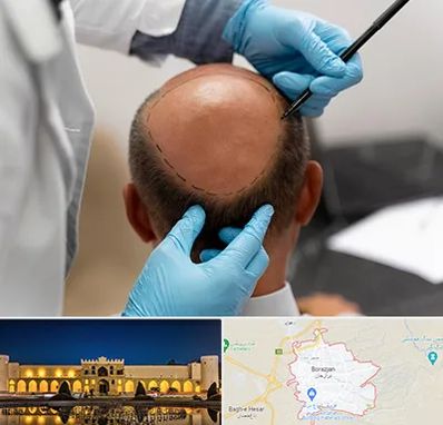 آموزش کاشت مو در برازجان