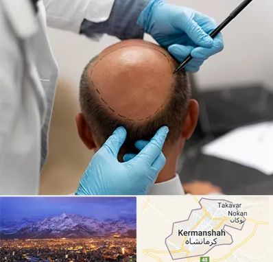 آموزش کاشت مو در کرمانشاه