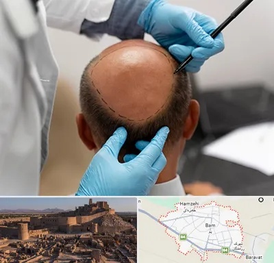 آموزش کاشت مو در بم