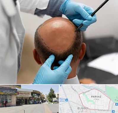 آموزش کاشت مو در پرواز تبریز