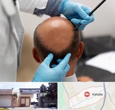 آموزش کاشت مو در وحیدیه شهریار