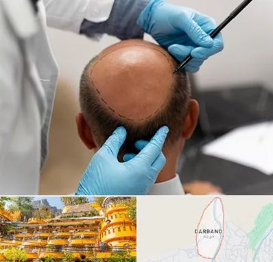 آموزش کاشت مو در دربند