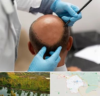 آموزش کاشت مو در بهبهان