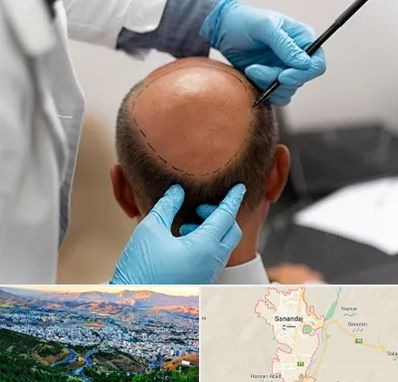 آموزش کاشت مو در سنندج