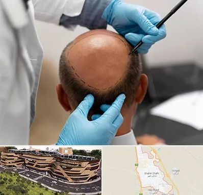 آموزش کاشت مو در شاهین شهر