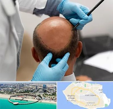 آموزش کاشت مو در کیش