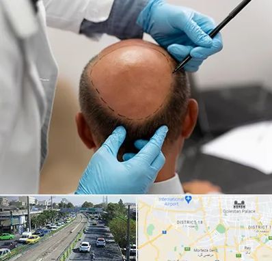 آموزش کاشت مو در جنوب تهران 