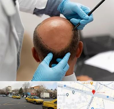 آموزش کاشت مو در شهناز تبریز