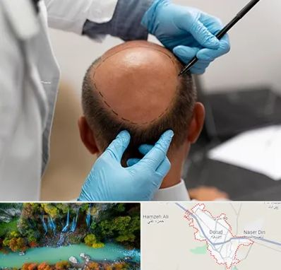 آموزش کاشت مو در دورود