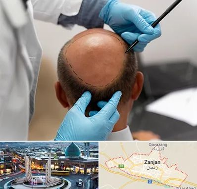 آموزش کاشت مو در زنجان