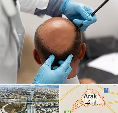 آموزش کاشت مو در اراک