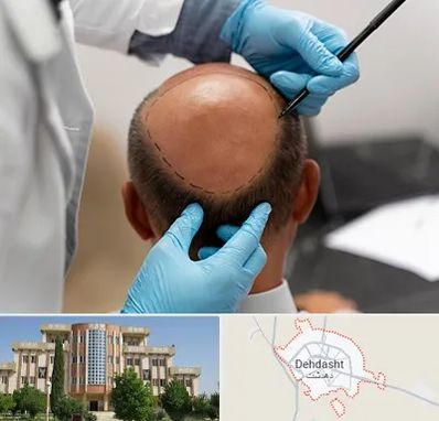 آموزش کاشت مو در دهدشت