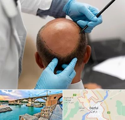 آموزش کاشت مو در دزفول