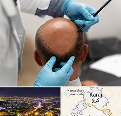 آموزش کاشت مو در کرج