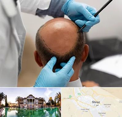 آموزش کاشت مو در شیراز