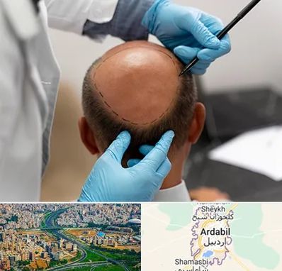 آموزش کاشت مو در اردبیل