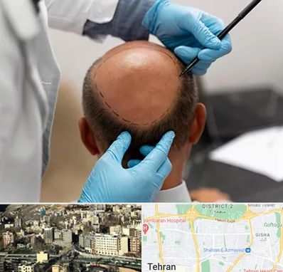 آموزش کاشت مو در مرزداران 