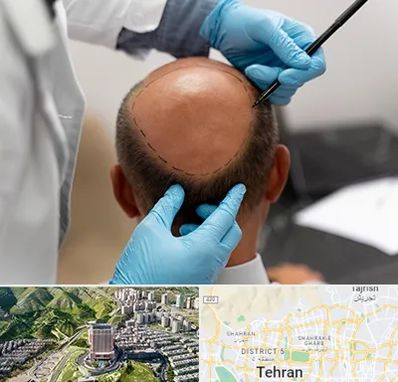 آموزش کاشت مو در شمال تهران 