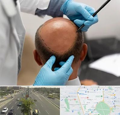 آموزش کاشت مو در منطقه 17 تهران 